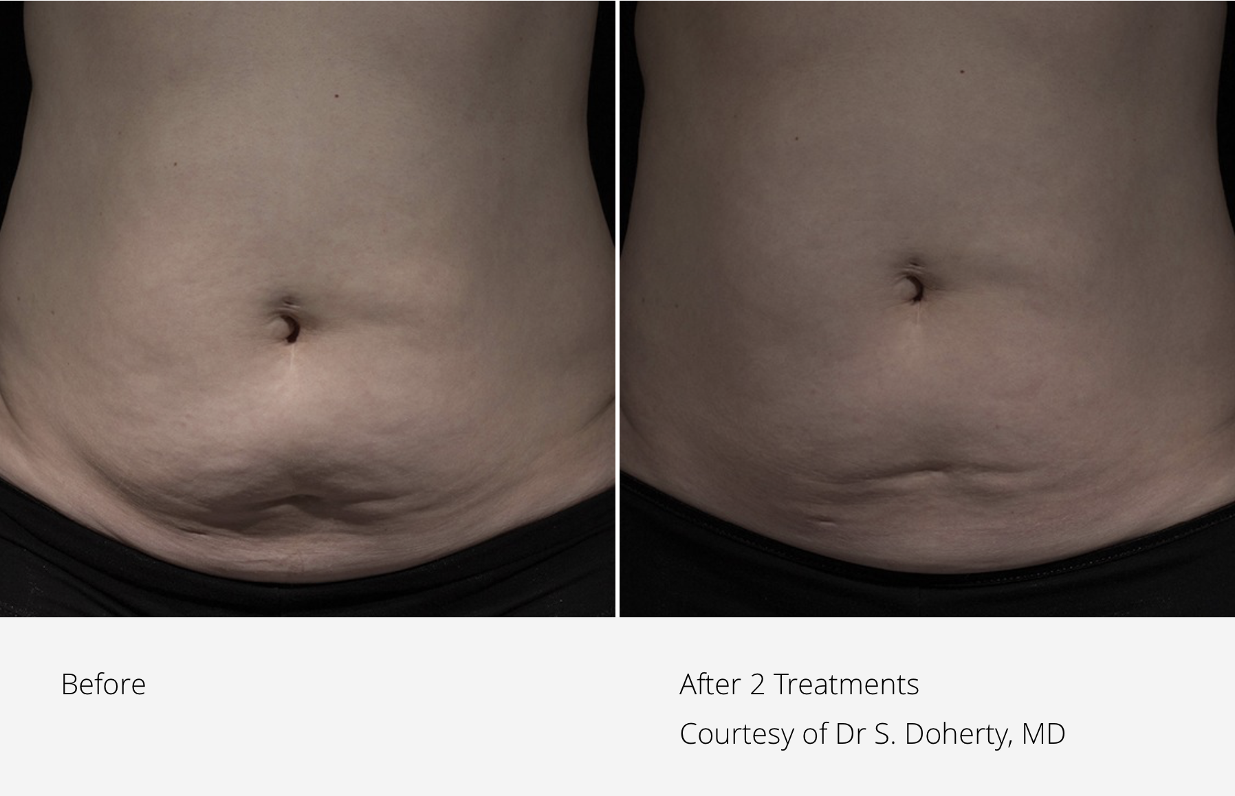 Potenza RF Before and After Results - Image 1