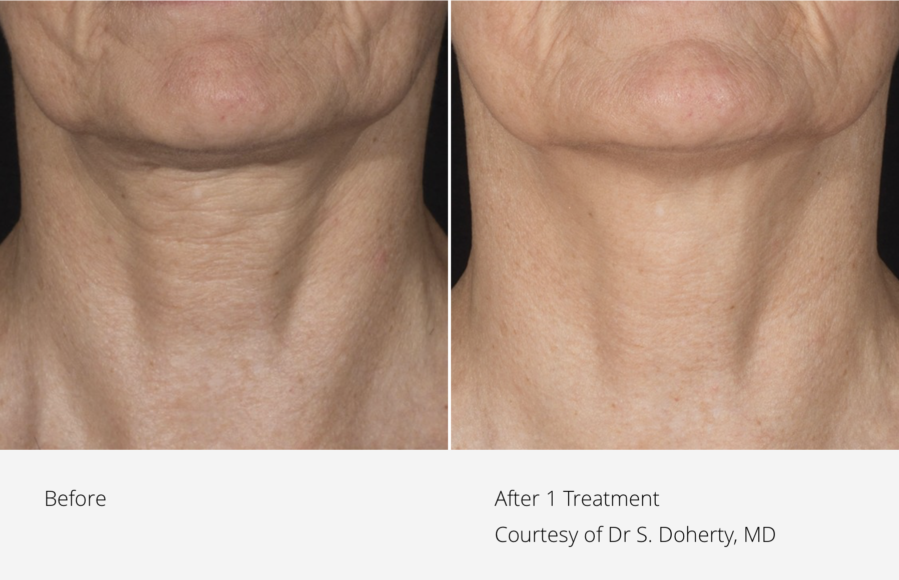 Potenza RF Before and After Results - Image 2